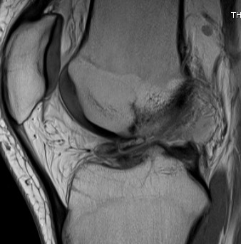 MRI Knee Loose Body In Notch